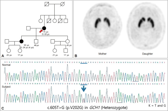 A Novel Variant of GCH1 in Dopa-Responsive Dystonia With Oculogyric Crises and Intrafamilial Phenotypic Heterogeneity.