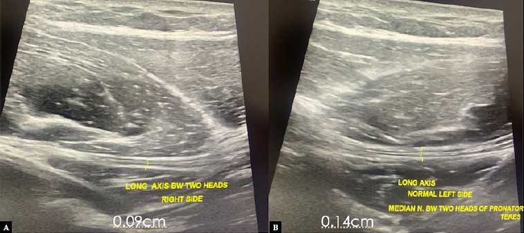 Ultrasound-guided median nerve hydrodissection of pronator teres syndrome: a case report and a literature review.