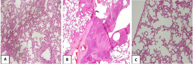 Protective efficacy of pirfenidone in rats with pulmonary fibrosis induced by bleomycin.