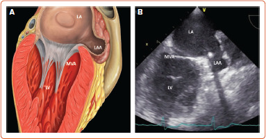 Percutaneous Left Atrial Appendage Occlusion: What the Practising Physician Should Know.