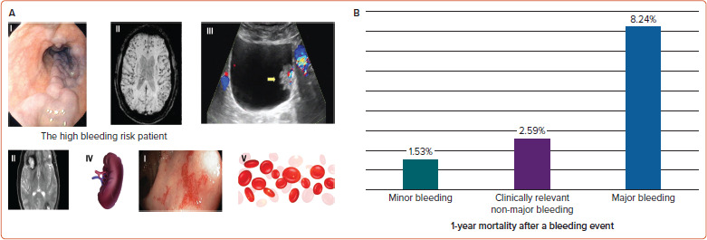 Percutaneous Left Atrial Appendage Occlusion: What the Practising Physician Should Know.