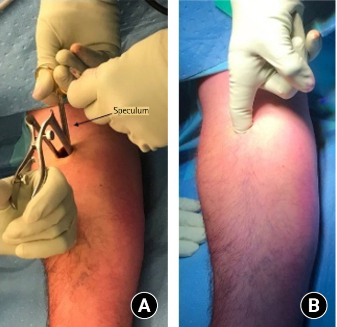 Minimally invasive distal biceps tendon repair: a case series.