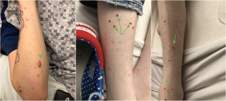 Rash in a Patient With New-Onset Type 1 Diabetes Mellitus