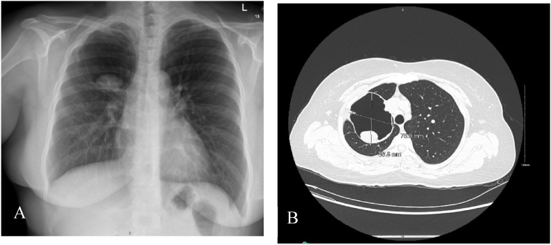 Congenital pulmonary airway malformation complicated by aspergilloma: A rare adulthood presentation - Case report