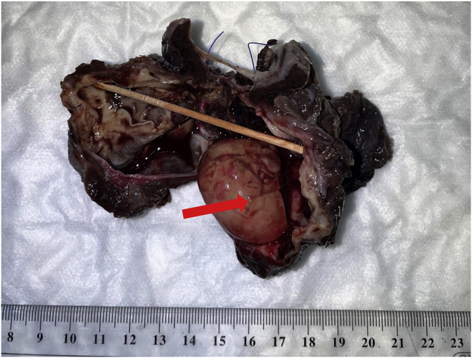 Congenital pulmonary airway malformation complicated by aspergilloma: A rare adulthood presentation - Case report