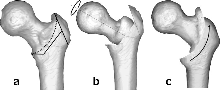 Intertrochanteric curved varus osteotomy for subchondral fracture of the femoral head: a case series.