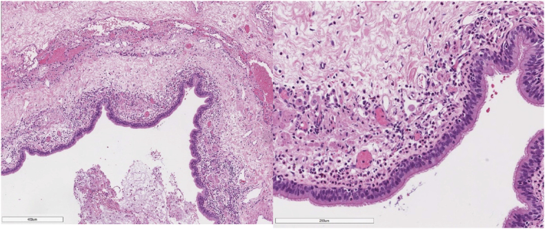 Congenital pulmonary airway malformation complicated by aspergilloma: A rare adulthood presentation - Case report