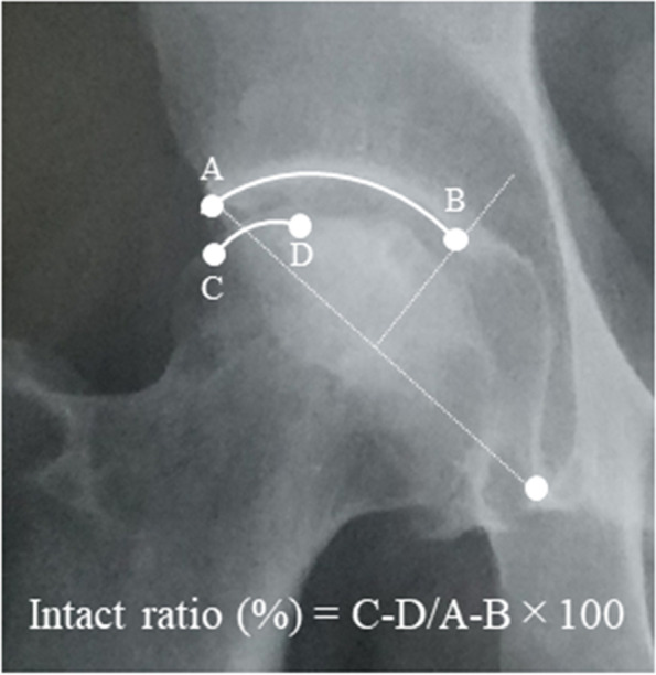 Intertrochanteric curved varus osteotomy for subchondral fracture of the femoral head: a case series.