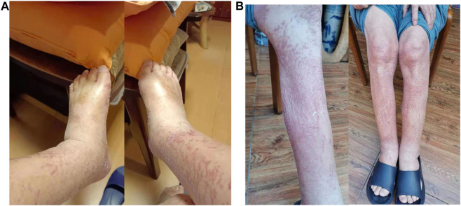 Case report: Clinical experience of treating pembrolizumab-induced systemic capillary leak syndrome (SCLS) in one patient with metastatic gastroesophageal junction squamous cell carcinoma.