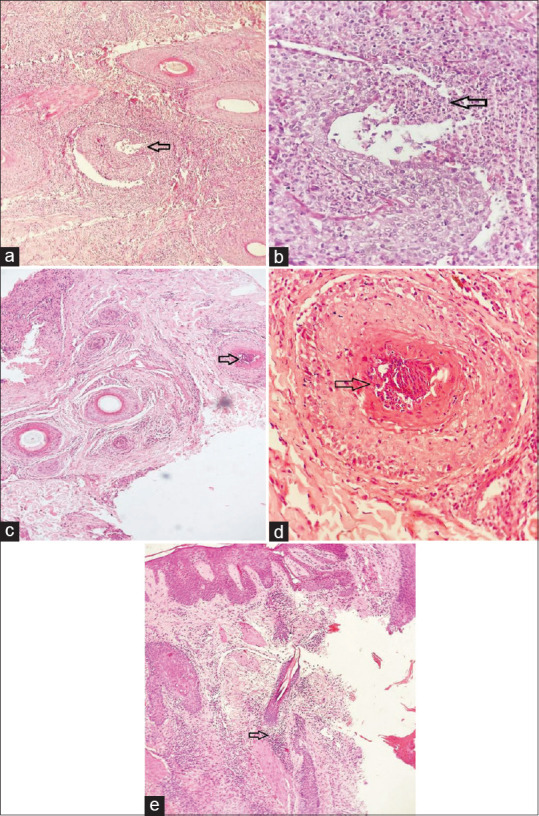 Clinicopathology, Trichoscopy, and Treatment Responsiveness of Folliculitis Decalvans: A Case Series of Three Pediatric Cases.