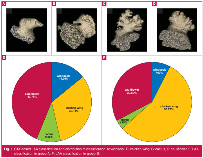 Application of computed tomographic angiography and echocardiography in predicting left atrial appendage thrombosis in patients with non-valvular atrial fibrillation.
