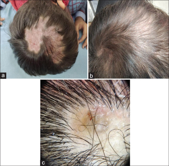 Clinicopathology, Trichoscopy, and Treatment Responsiveness of Folliculitis Decalvans: A Case Series of Three Pediatric Cases.