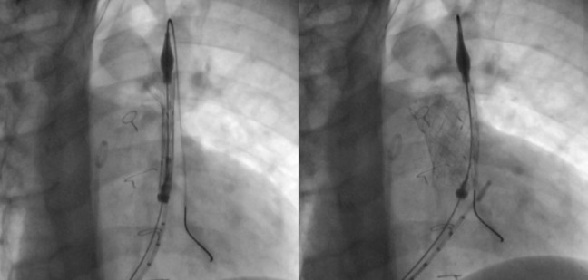 [The PULSTA valve in native right ventricular outflow tract: initial experience in 3 Spanish hospitals].