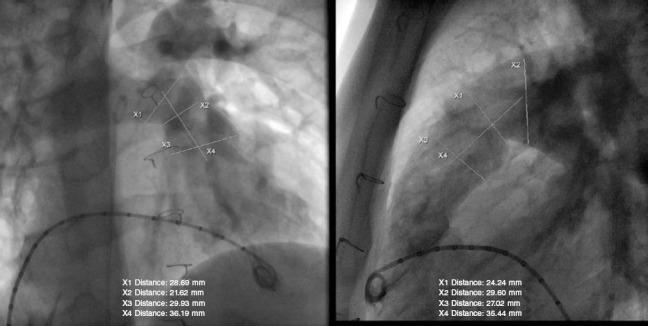 [The PULSTA valve in native right ventricular outflow tract: initial experience in 3 Spanish hospitals].