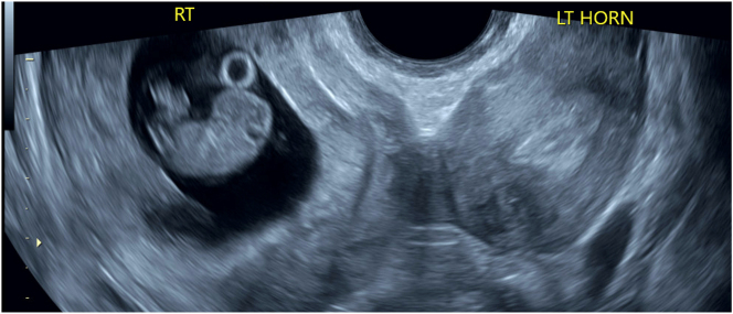 A successful vaginal birth after cesarean in a patient with uterine didelphys.
