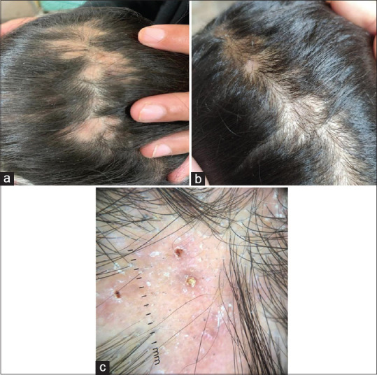 Clinicopathology, Trichoscopy, and Treatment Responsiveness of Folliculitis Decalvans: A Case Series of Three Pediatric Cases.