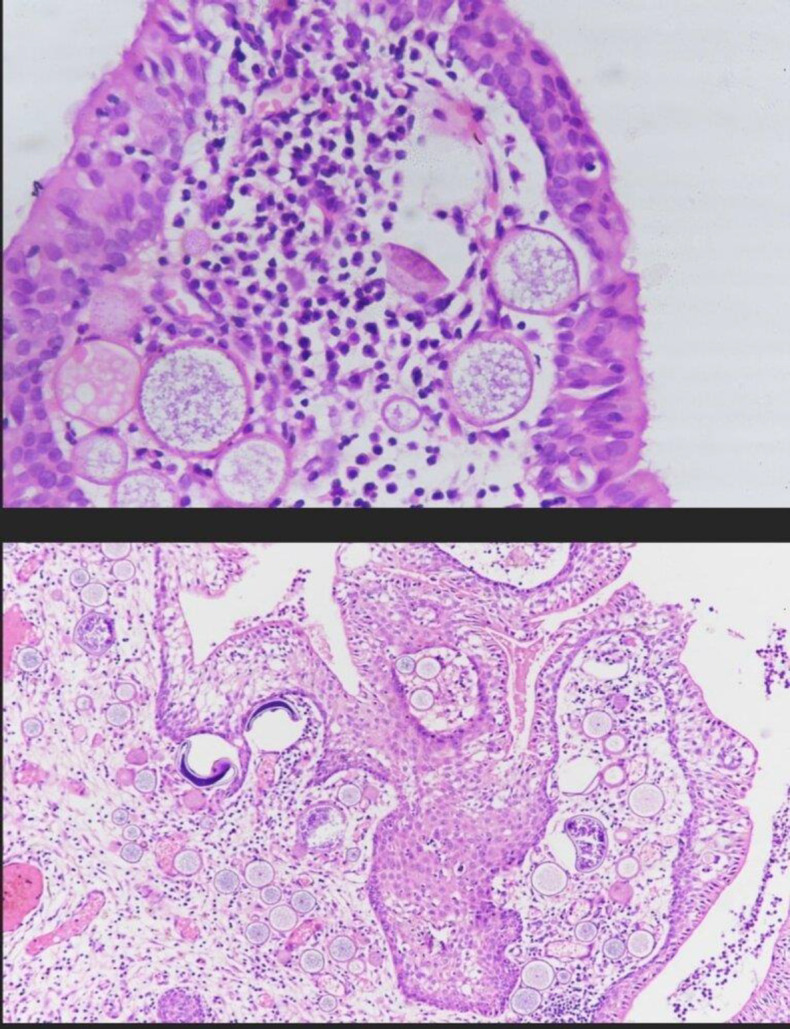 Rhinosporidiosis- Epidemiological, Clinicoradiological, Immunological Profile.