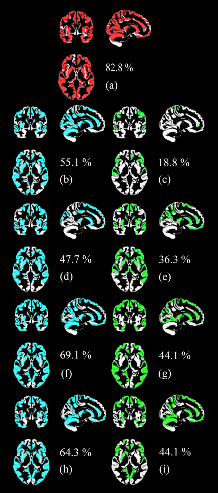 Examining the Dominant Presence of Brain Grey Matter in Autism During Functional Magnetic Resonance Imaging.