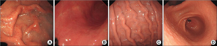 Validation of a Novel Endoscopic Feature that Predicts <i>Helicobacter pylori</i>-negative Status: Does the Scratch Sign Reflect <i>H. pylori</i> Non-infection?