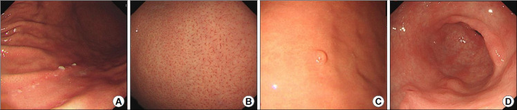 Validation of a Novel Endoscopic Feature that Predicts <i>Helicobacter pylori</i>-negative Status: Does the Scratch Sign Reflect <i>H. pylori</i> Non-infection?