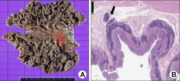 [Gastric Cancer of the Cardia Detected on Screening Endoscopy].