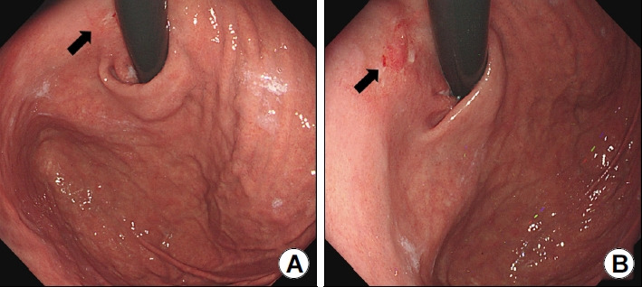 [Gastric Cancer of the Cardia Detected on Screening Endoscopy].