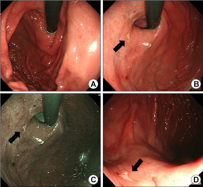 [Gastric Cancer of the Cardia Detected on Screening Endoscopy].