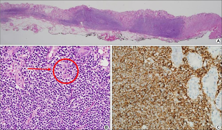 Endoscopic Submucosal Dissection for Treatment of Localized Gastric Mucosa-associated Lymphoid Tissue Lymphoma: A Case Series.