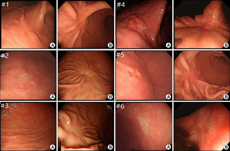 Endoscopic Submucosal Dissection for Treatment of Localized Gastric Mucosa-associated Lymphoid Tissue Lymphoma: A Case Series.