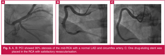 Kounis syndrome caused by bee sting: a case report and literature review.