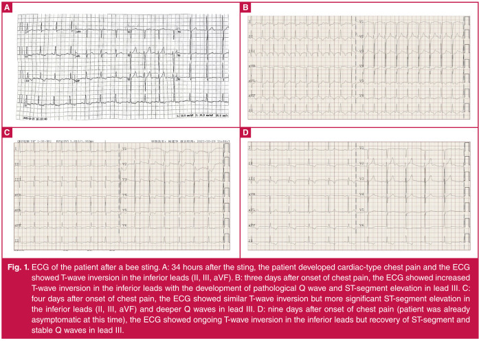 Kounis syndrome caused by bee sting: a case report and literature review.