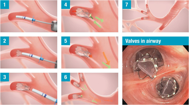 A Case Study of a Transplant Candidate With Stress-Induced Takotsubo Cardiomyopathy.