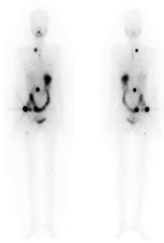 Establishing a Cutoff Serum Thyroglobulin Value for the Diagnosis and Management of Well-Differentiated Thyroid Cancer.