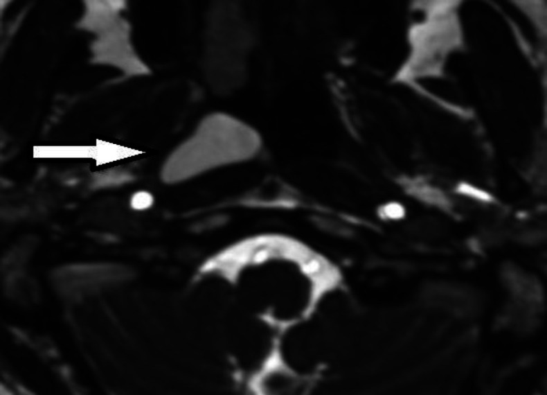 Nasopharyngeal Branchial Cyst and Thornwaldt Cyst in a Patient with Hearing Loss after Coronavirus Infection.