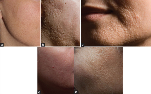 Symmetric Idiopathic MicroPapular Facial Eruption or SIMPLE - Description of a New Entity Featuring Facial Vellus Hair Lichen Planopilaris in the Absence of Frontal Fibrosing Alopecia.