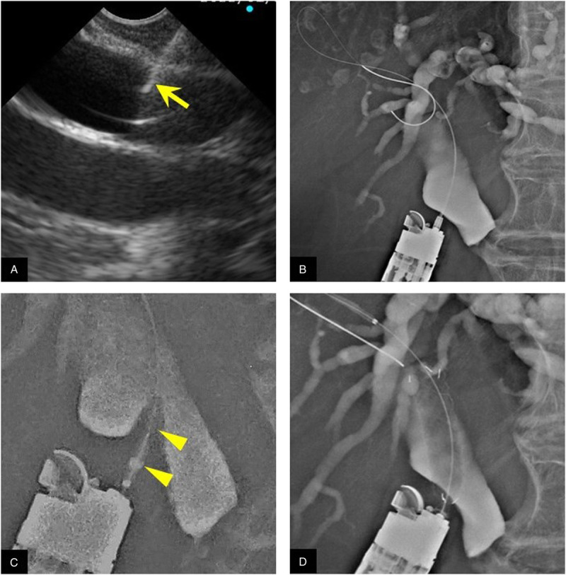 Prospective clinical trial of EUS-guided choledochoduodenostomy without fistula dilation for malignant distal biliary obstruction.