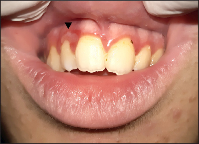 Spongiotic Gingival Hyperplasia in a Child with Asperger Syndrome: a Case Report.