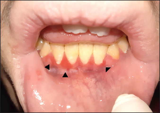 Spongiotic Gingival Hyperplasia in a Child with Asperger Syndrome: a Case Report.