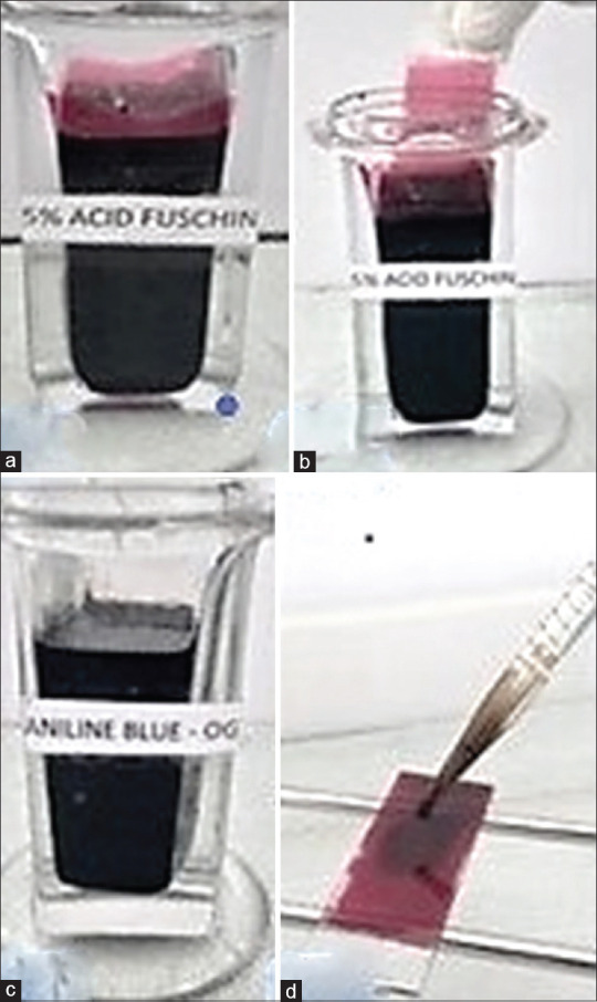 "Ayoub-Shklar" as a Special Stain for Keratin: A Histopathological Study.