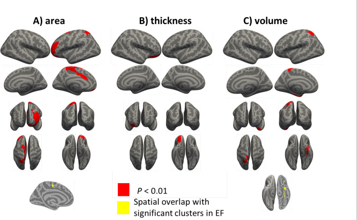 Cortical Morphology in Cannabis Use Disorder: Implications for Transcranial Direct Current Stimulation Treatment.