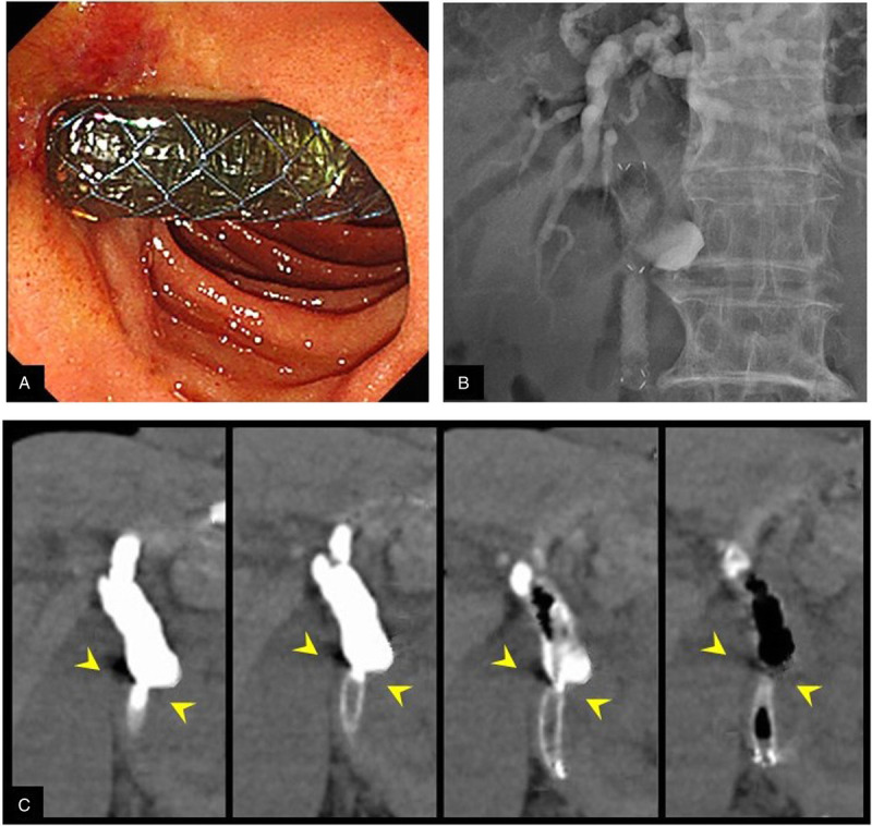 Prospective clinical trial of EUS-guided choledochoduodenostomy without fistula dilation for malignant distal biliary obstruction.
