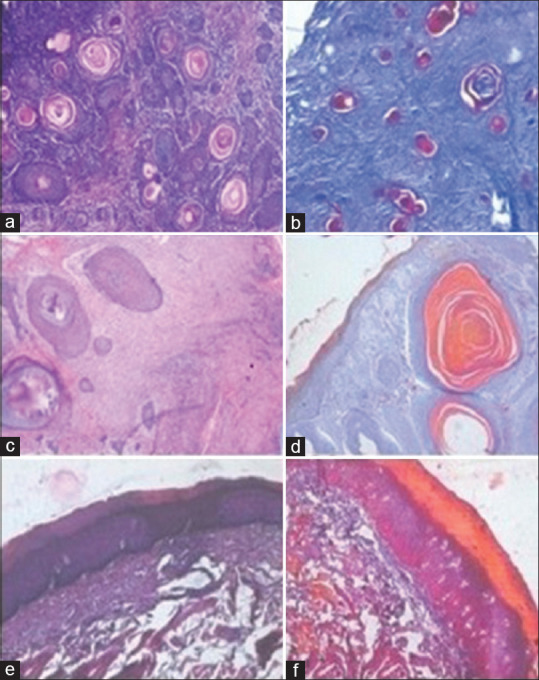 "Ayoub-Shklar" as a Special Stain for Keratin: A Histopathological Study.