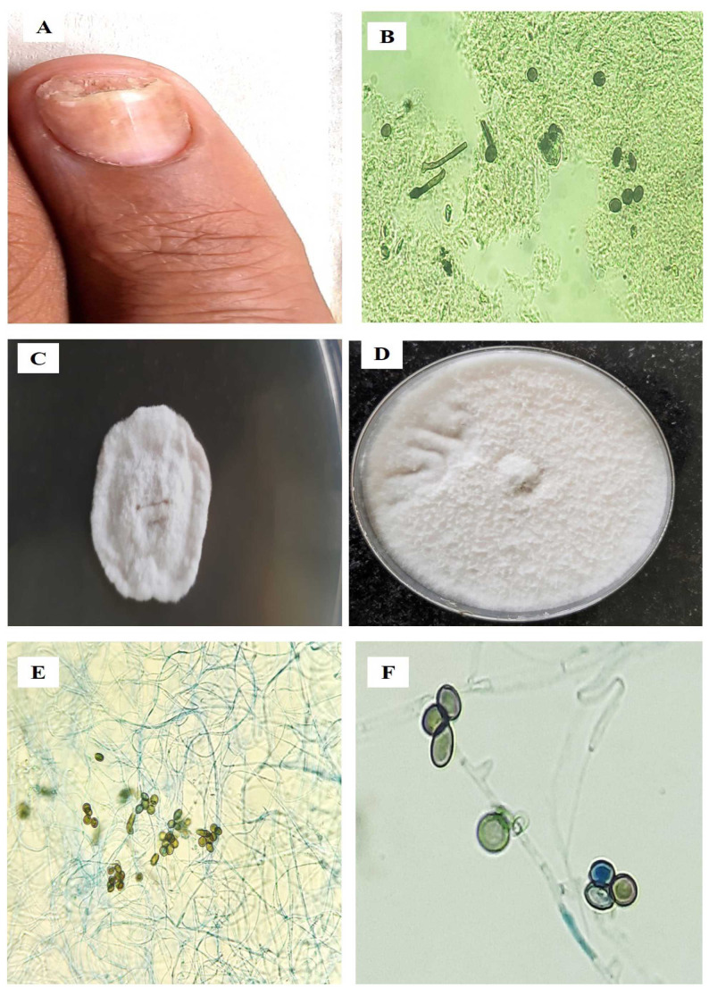 Onychomycosis caused by dematiaceous fungi: A four-year study on agricultural workers of Assam, India.