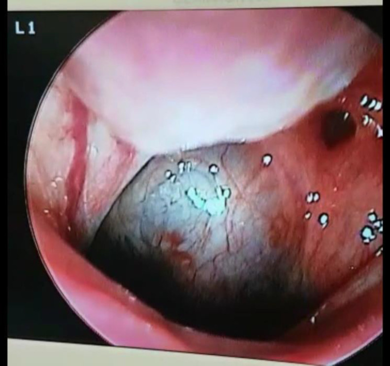 Nasopharyngeal Branchial Cyst and Thornwaldt Cyst in a Patient with Hearing Loss after Coronavirus Infection.
