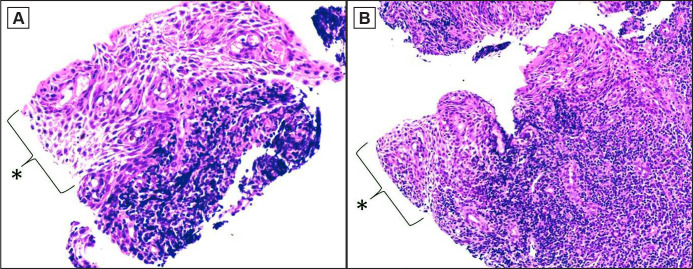 Spongiotic Gingival Hyperplasia in a Child with Asperger Syndrome: a Case Report.