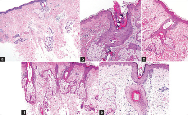 Symmetric Idiopathic MicroPapular Facial Eruption or SIMPLE - Description of a New Entity Featuring Facial Vellus Hair Lichen Planopilaris in the Absence of Frontal Fibrosing Alopecia.