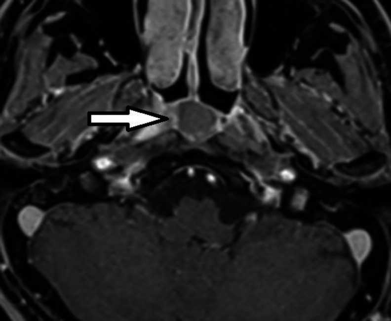 Nasopharyngeal Branchial Cyst and Thornwaldt Cyst in a Patient with Hearing Loss after Coronavirus Infection.