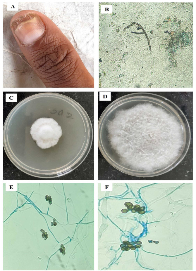 Onychomycosis caused by dematiaceous fungi: A four-year study on agricultural workers of Assam, India.