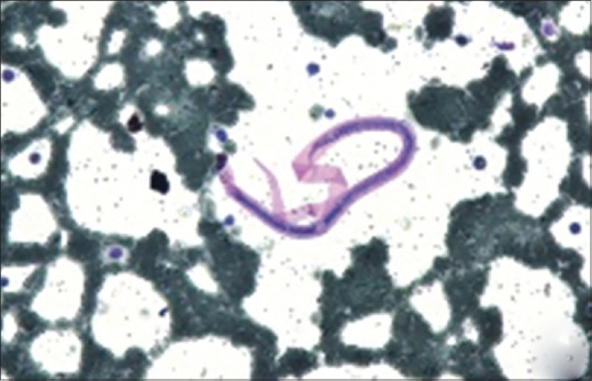 Morphological Spectrum of Bone Marrow Aspirates in Infections: A Clinico-Hematological Analysis.
