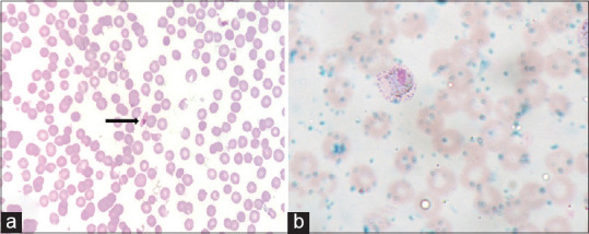 Morphological Spectrum of Bone Marrow Aspirates in Infections: A Clinico-Hematological Analysis.